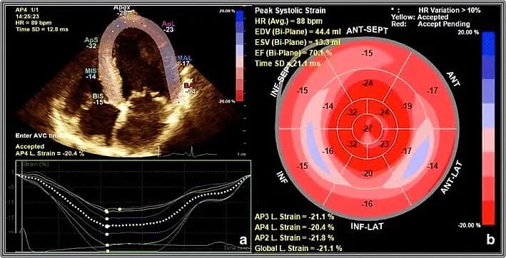 Bull’s-eye map of peak systolic strain across the heart muscle segments